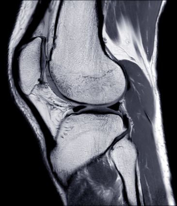 ACL Surgery Price Turkey