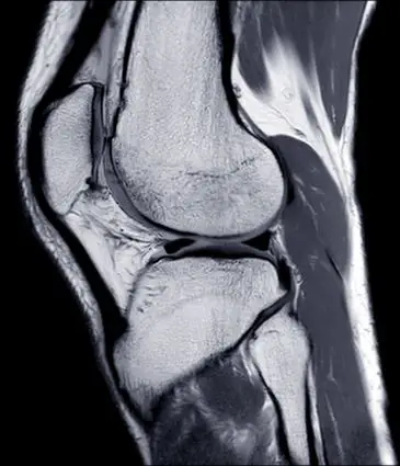 ACL Surgery