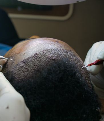Prix ​​de la Greffe de cheveux afro en Turquie