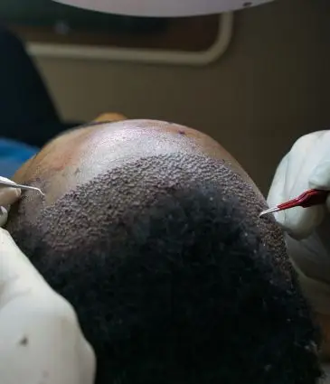 Afro Haartransplantation Preis Türkei