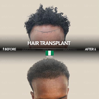 Greffe de cheveux afro