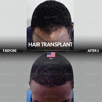 Afro Hair Transplant in Turkey