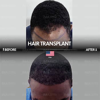 Greffe de cheveux afro en Turquie