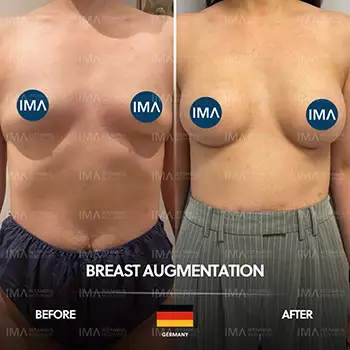 Breast Augmentation Before After Price