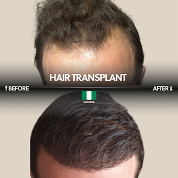 Greffe de cheveux DHI
