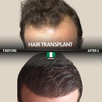 DHI Hair Transplant