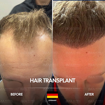 Greffe de cheveux DHI en Turquie