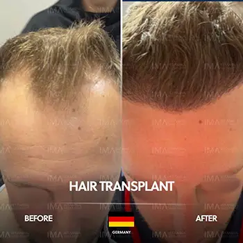 زراعة الشعر بتقنية DHI في تركيا