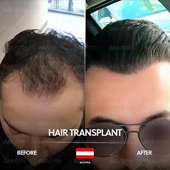 Prix ​​de la greffe de cheveux DHI