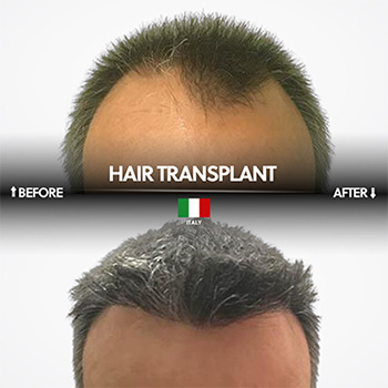 Greffe de cheveux FUE en Turquie