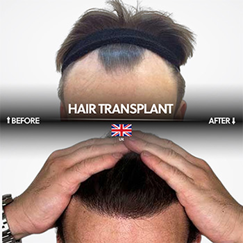 Prix ​​de la greffe de cheveux FUE