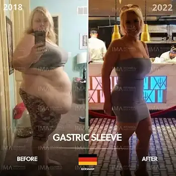 Endoscopic Sleeve Gastroplasty Before After