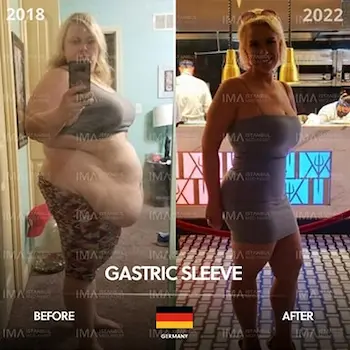 Gastric Sleeve Before After Price