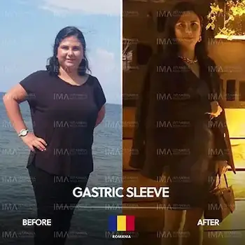 Gastroplastie endoscopique à manchon avant et après Turquie