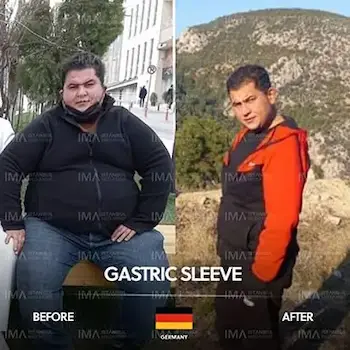 Endoscopic Sleeve Gastroplasty Before After Price Turkey