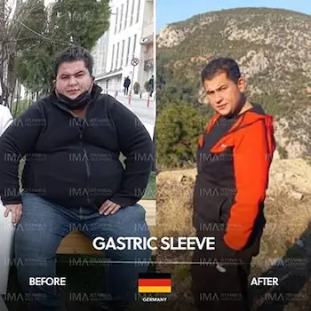 Gastric Sleeve Before After Turkey