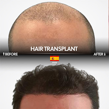 Hair Transplant Before After