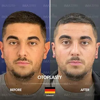 Otoplastik-Chirurgie in der Türkei