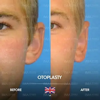 تكلفة عملية تجميل الأذن