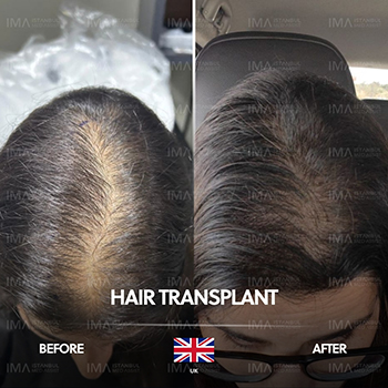 Greffe de cheveux pour femmes