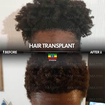 Greffe de cheveux pour femmes en Turquie