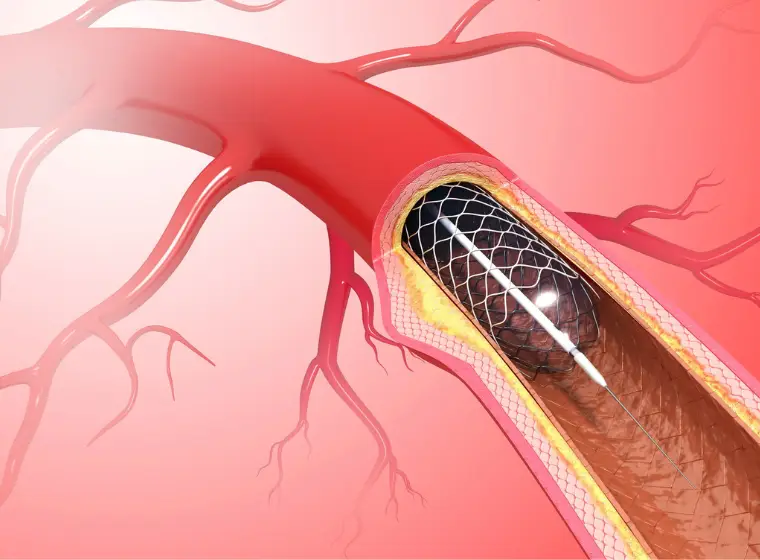 Angioplasty and Stent Procedures in Turkey