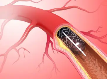Angioplastie und Stent-Eingriffe in der Türkei