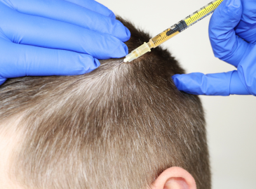 Exosome Hair Transplants in Turkey