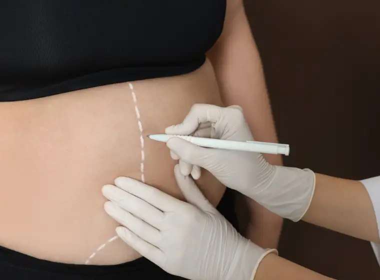 Liposuccion en Turquie: coûts, rétablissement et résultats