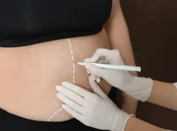 Liposuction in Turkey: Costs, Recovery and Results