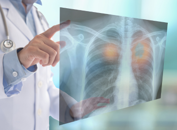 Scanner à faible dose pour le cancer du poumon