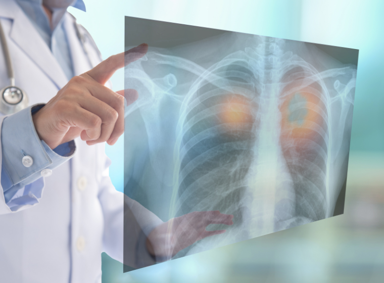 Low-dose CT scan for lung cancer