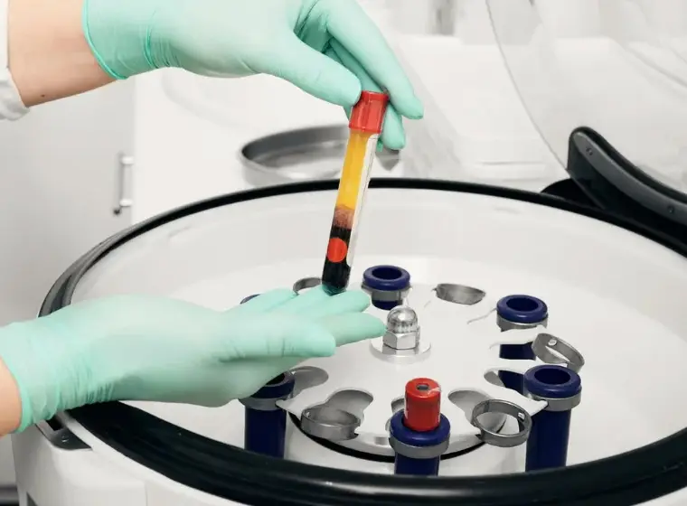 Platelet-Rich Plasma (PRP): Transforming IVF for Better