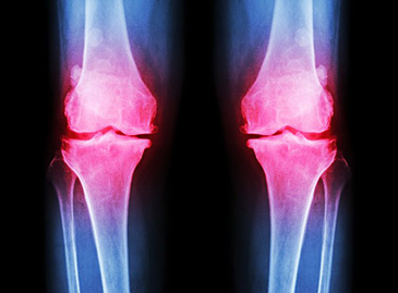 Quel est le traitement le plus récent contre l’arthrose?