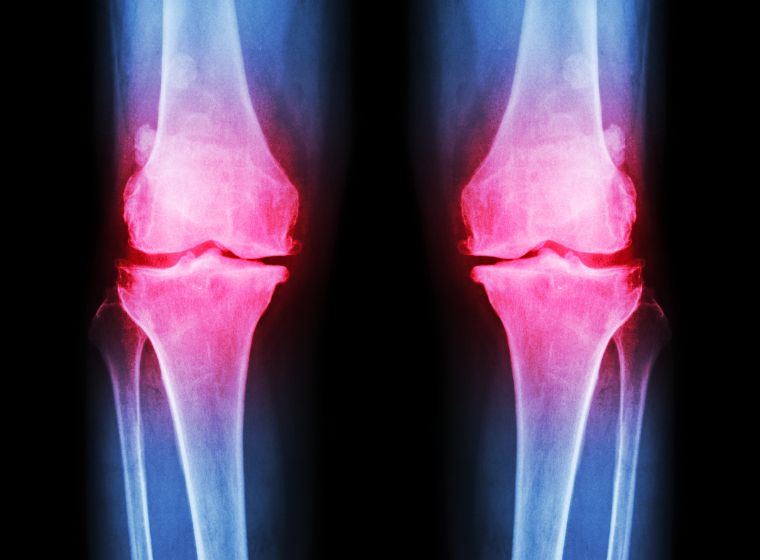 Quel est le traitement le plus récent contre l’arthrose?