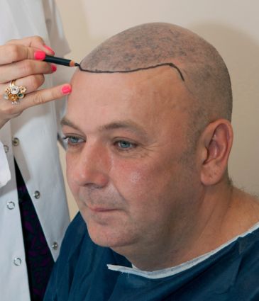 DHI Hair Transplant Price Turkey