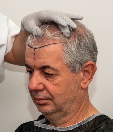 DHI Hair Transplant
