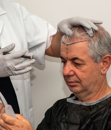 Prix ​​de la Greffe de cheveux FUE en Turquie