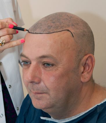 FUE Hair Transplant