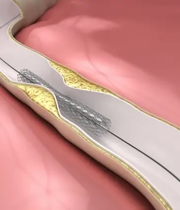 Angioplastie Coronarienne & Pose de Stent
