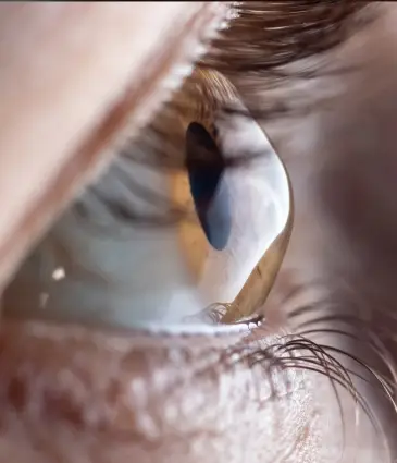 Eye Diseases & Treatments