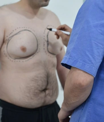 Gynecomastia Price Turkey