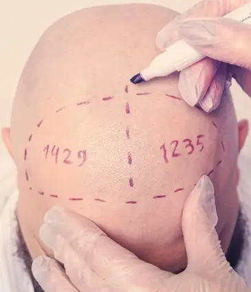 Hair Transplant