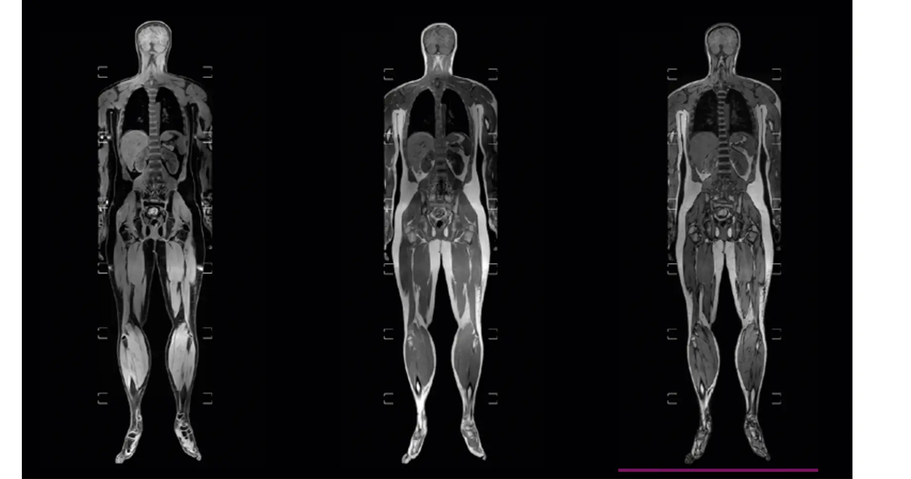 Whole Body MRI