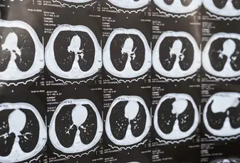 Low-Dose Lung CT