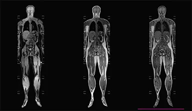 Whole Body MRI
